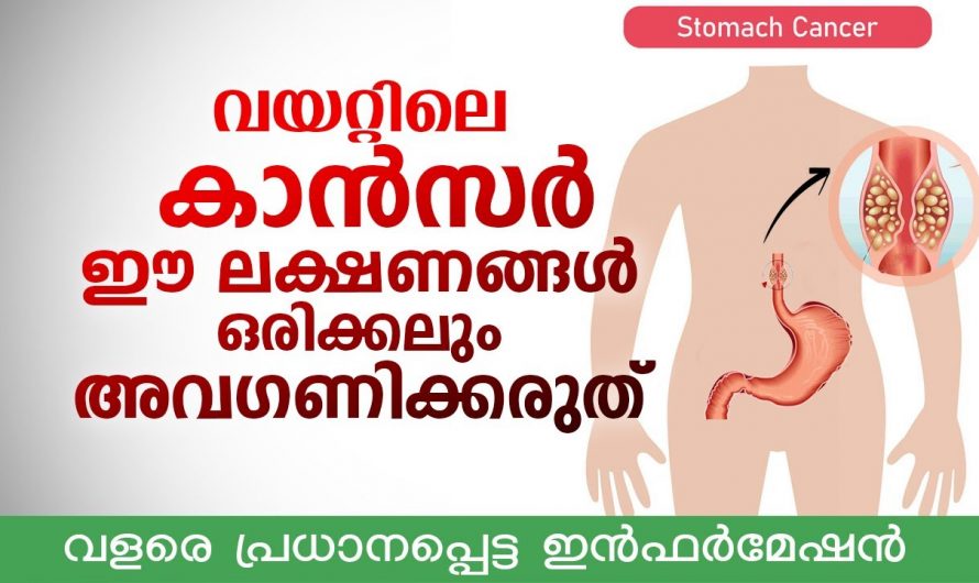 ഇത്തരം ലക്ഷണങ്ങൾ നിങ്ങളിൽ കാണാറുണ്ടോ ? ഇത് ഒരിക്കലും നിസ്സാരമായി കാണരുത് കണ്ടു നോക്കൂ…| Stomach cancer symptoms