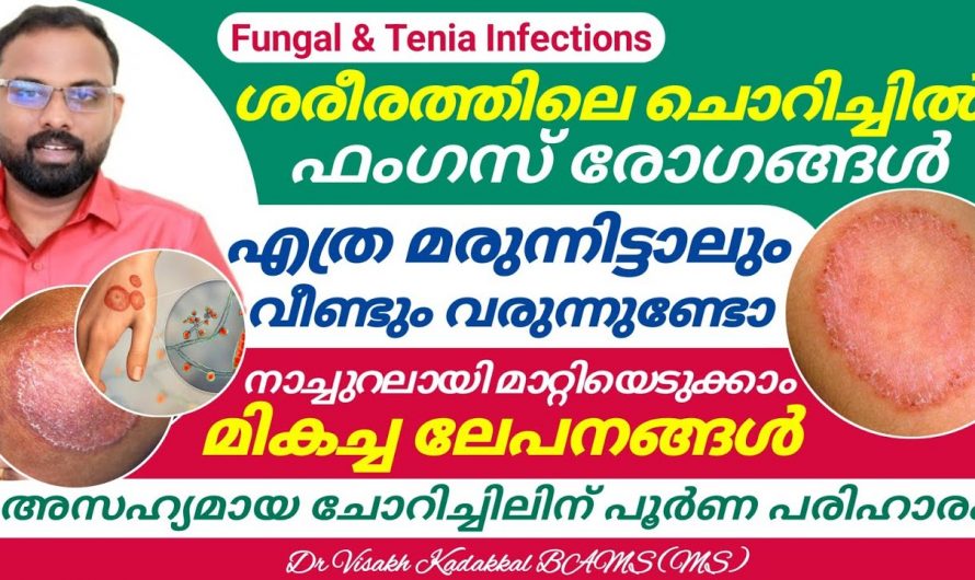 ചൊറിച്ചിൽ ഉണ്ടാക്കുന്ന രോഗാവസ്ഥകളുടെ കാരണങ്ങൾ ഇതുവരെയും അറിയാതെ പോയല്ലോ. കണ്ടു നോക്കൂ…| Fungus and tinea infection