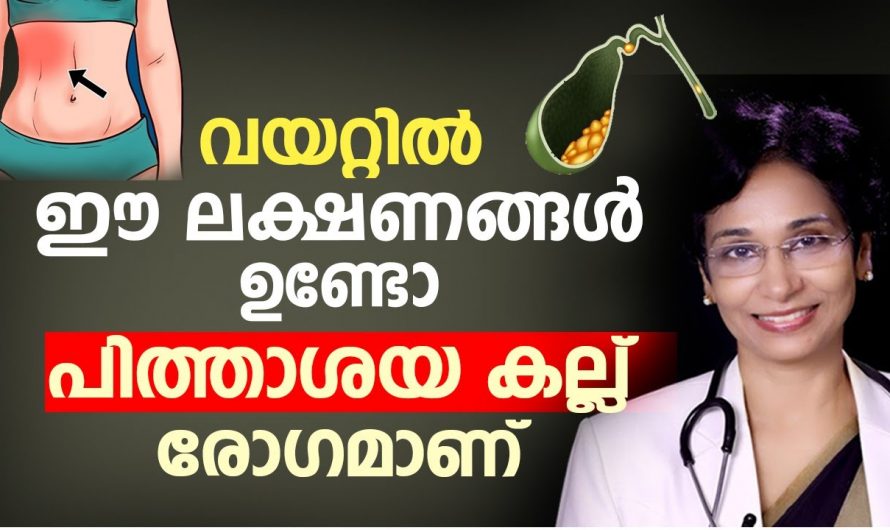 പിത്താശയെ കല്ല്  മൂലം ഉണ്ടാകുന്ന  അവസ്ഥകളും അവയ്ക്കുള്ള പ്രതിവിധികളും നമുക്കറിയാനായിട്ട് കണ്ടു നോക്കൂ…| Pithashayathil kallu maran