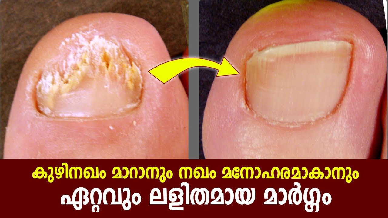 Best home remedies for toenail fungus