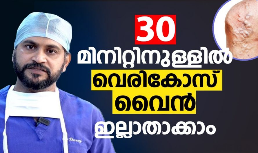 ഓപ്പൺ സർജറികൾ ഇല്ലാതെ തന്നെ വെരിക്കോസ് വെയിനിനെ മിനിറ്റുകൾക്കുള്ളിൽ മാറ്റാം. ഇത്തരം കാര്യങ്ങൾ ആരും കാണാതെ പോകരുതേ…| When to worry about varicose veins