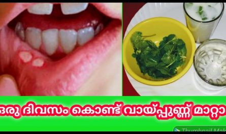 Best mouth ulcer treatment