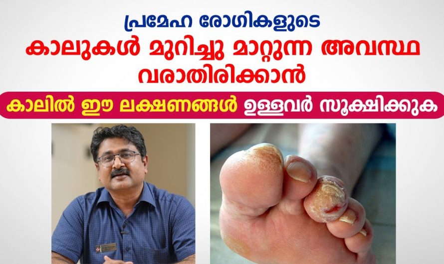 അമിതമായി തരിപ്പ് മരവിപ്പ് എന്നിവ കാലുകളിൽ കാണാറുണ്ടോ ? ഇത് കാലുകൾ മുറിച്ചുമാറ്റുന്ന അവസ്ഥയിലേക്ക് എത്താം. കണ്ടു നോക്കൂ…| Prevent Amputation