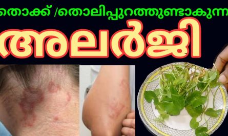 Skin Allergy Treatment at Home