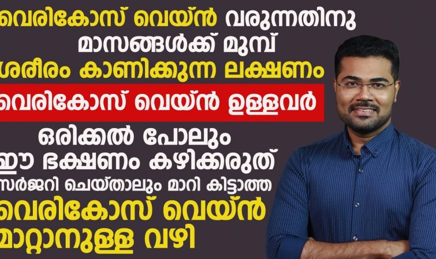 സർജറി കൂടാതെ തന്നെ വെരിക്കോസ് വെയിനിനെ ജീവിതശൈലിയിലൂടെ മാറ്റിയെടുക്കാം. ഇതാരും നിസ്സാരമായി തള്ളിക്കളയരുതേ…| Varicose vein treatment near me