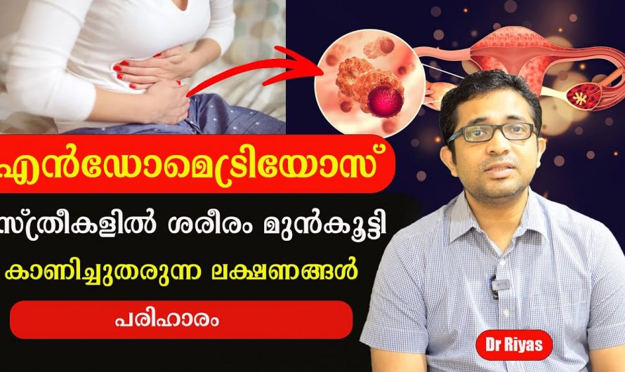 ആർത്തവ സമയത്തെ  അസ്വസ്ഥതകൾ മാറാതെ നീണ്ടുനിൽക്കുന്നുണ്ടോ?  ഇതിന്റെ യഥാർത്ഥ കാരണത്തെ ആരും തിരിച്ചറിയാതെ പോകരുതേ…| Endometriosis symptoms and signs