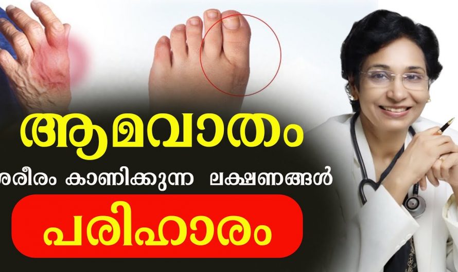 കൈകാലുകളുടെ അഗ്രഭാഗം ചുവപ്പ് നിറത്തോട് കൂടി വേദനാജനകമാകാറുണ്ടോ? എങ്കിൽ ഇതിനെ ആരും നിസ്സാരമായി കാണരുതേ…| What causes gout in feet