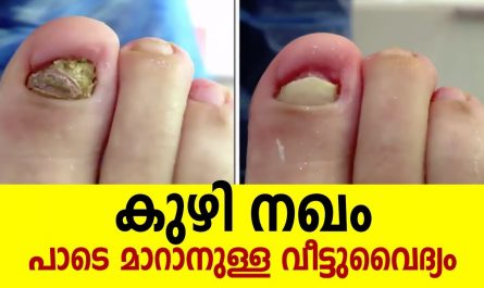 Toenail infection causes