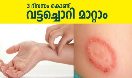 Home remedy for Ringworm