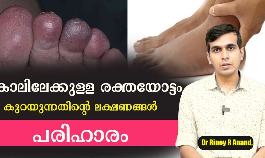 കാലുകളിലെ രക്തക്കുഴലുകളിൽ രക്തം കട്ടപിടിക്കുമ്പോൾ പ്രകടമാകുന്ന ലക്ഷണങ്ങളെ ആരും കാണാതെ പോകരുതേ.