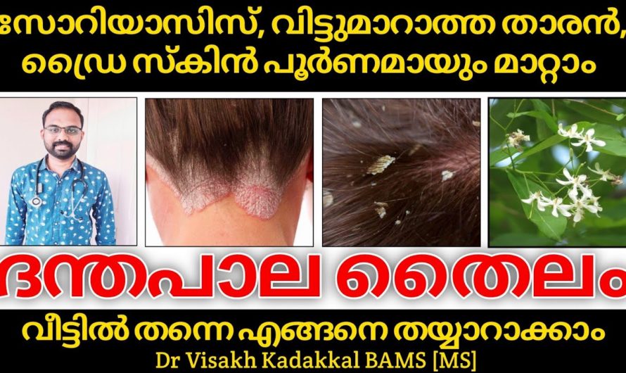 താരൻ വരണ്ട ചർമം സോറിയാസിസ് എന്നിവയെ മറികടക്കാൻ ഈ ഒരു എണ്ണ മതി. ഇതിന്റെ ഗുണങ്ങൾ ആരും അറിയാതെ പോകരുതേ…| Dantapala Oil for Psoriasis