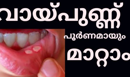 Mouth ulcer home remedy
