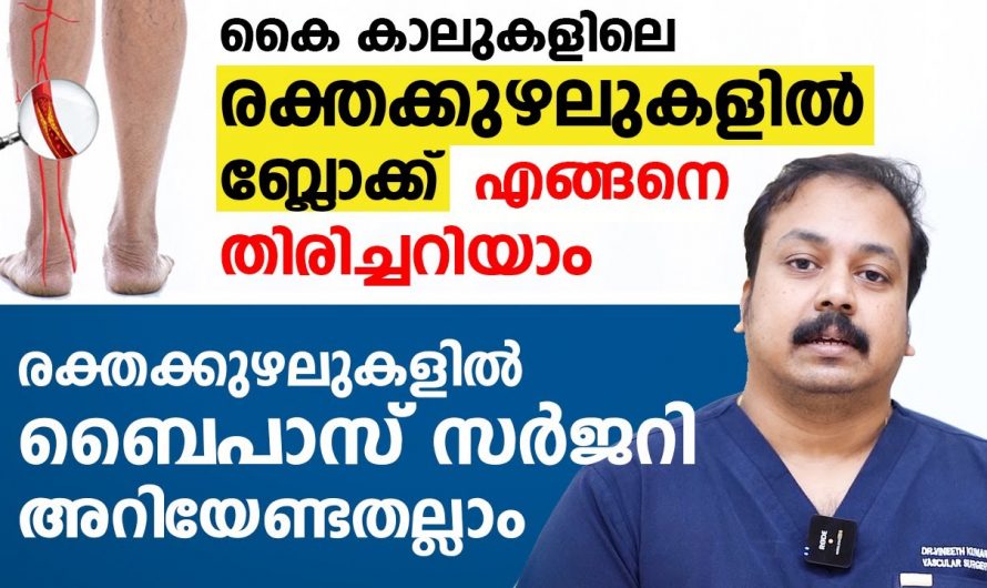 കൈകാലുകളിലെ രക്തധമനികളിൽ ബ്ലോക്കുകളും ഉണ്ടാകുമ്പോൾ ചെയ്യാൻ സാധിക്കുന്ന ബൈപ്പാസ് സർജറിയെ കുറിച്ച് ആരും കാണാതെ പോകരുതേ…| Peripheral artery Bypass surgery