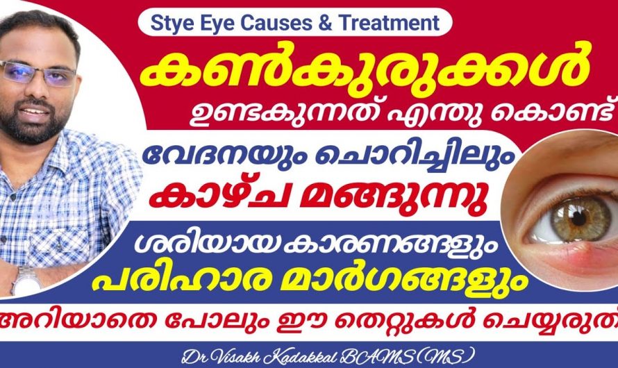 അടിക്കടി കണ്ണുകളിൽ ഉണ്ടാകുന്ന കൺകുരുവിനെ മാറ്റാൻ ഇത്തരം കാര്യങ്ങൾ ആരും കണ്ടില്ലെന്ന് നടിക്കരുതേ…| Get rid of Eye stye