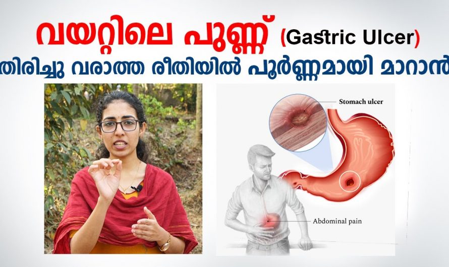 വയറ്റിലെ അൾസറുകൾ നിങ്ങളുടെ ജീവിതത്തിന്റെ താളം തെറ്റിക്കുന്നുണ്ടോ?  എങ്കിൽ അവ പരിഹരിക്കാൻ ഇത് ആരും കാണാതെ പോകരുതേ…| Ulcer home remedy malayalam