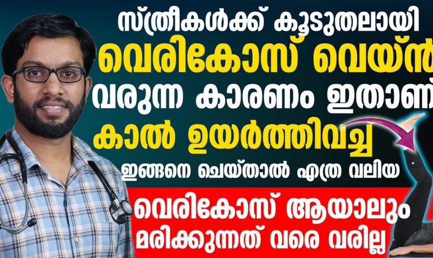 ജീവിതത്തിൽ ഒരിക്കലും വെരിക്കോസ് വരാതിരിക്കാനും വന്നവർക്ക് അത് എളുപ്പത്തിൽ മറികടക്കാനും ഇതാരും കാണാതെ പോകല്ലേ.