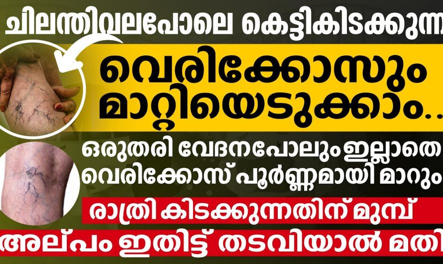 സർജറി പോലുമില്ലാതെ വെരിക്കോസിനെ പൂർണമായി മാറ്റാൻ ഇത്തരം കാര്യങ്ങൾ ആരും കാണാതെ പോകല്ലേ…| Varicose veins treatment in malayalam