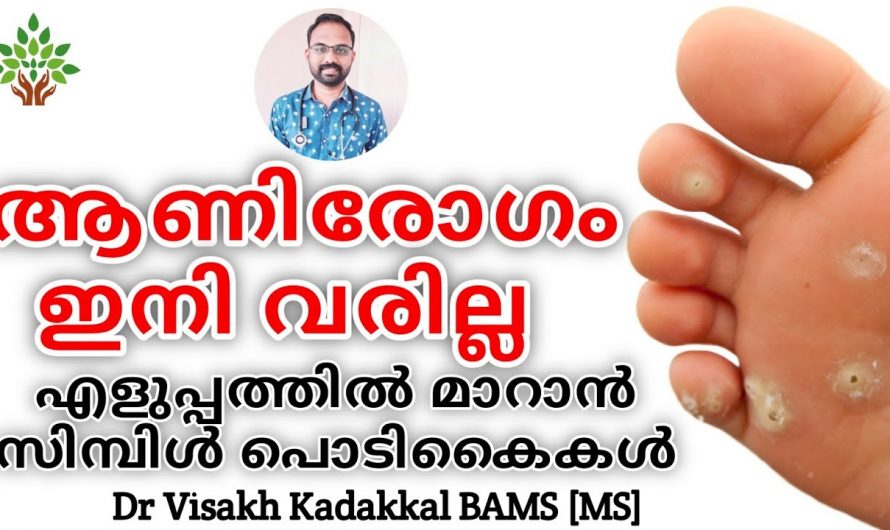 ആണി രോഗത്തെ ഈസിയായി മാറ്റാൻ ഇത് ആരും അറിയാതെ പോകരുതേ.