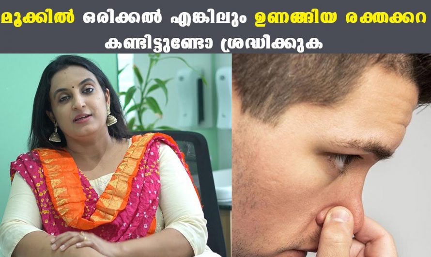 നിങ്ങളുടെ മൂക്കിൽ നിന്ന് രക്തം വരാറുണ്ടോ? എങ്കിൽ ഇതാരും കാണാതെ പോകരുതേ.