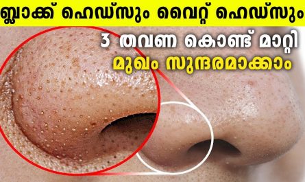 Blackheads and whiteheads removal