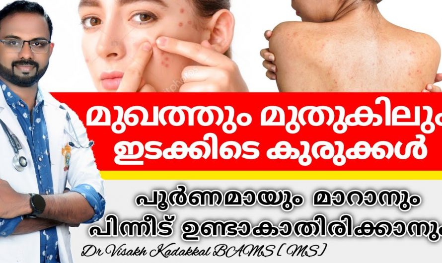 മുഖക്കുരുവിനെ മറികടക്കാൻ ഇത്രമാത്രം ചെയ്താൽ മതി. ഇതാരും നിസ്സാരമായി തള്ളിക്കളയരുതേ…| Pimple marks on shoulders and back