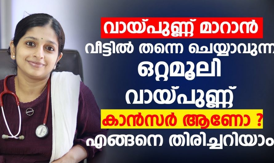 വായ്പുണ്ണിന്റെ യഥാർത്ഥ കാരണങ്ങളെയും പ്രതിരോധ മാർഗ്ഗങ്ങളെയും ആരും തിരിച്ചറിയാതെ പോകല്ലേ.