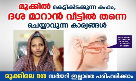 Nasal polyp symptoms and signs