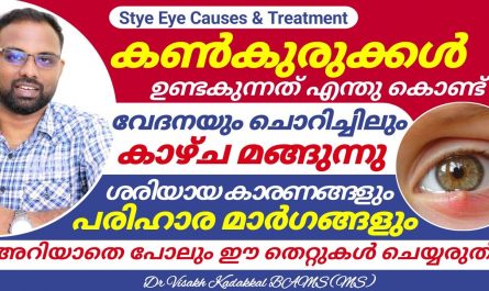Eye Stye Causes and Treatment