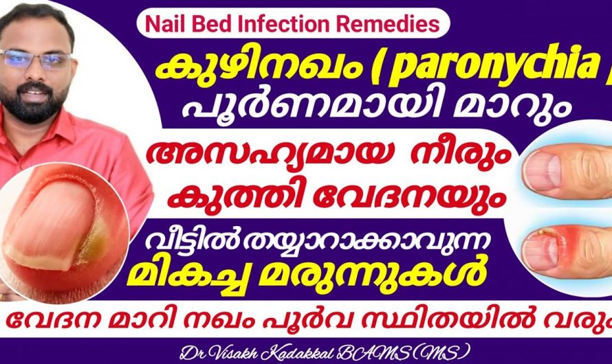 നഖത്തിന് ചുറ്റുമുള്ള നീരും ഇൻഫെക്ഷനും പൂർണമായി മാറ്റാം. ഇതാരും നിസ്സാരമായി തള്ളിക്കളയരുതേ…| Toenail infection