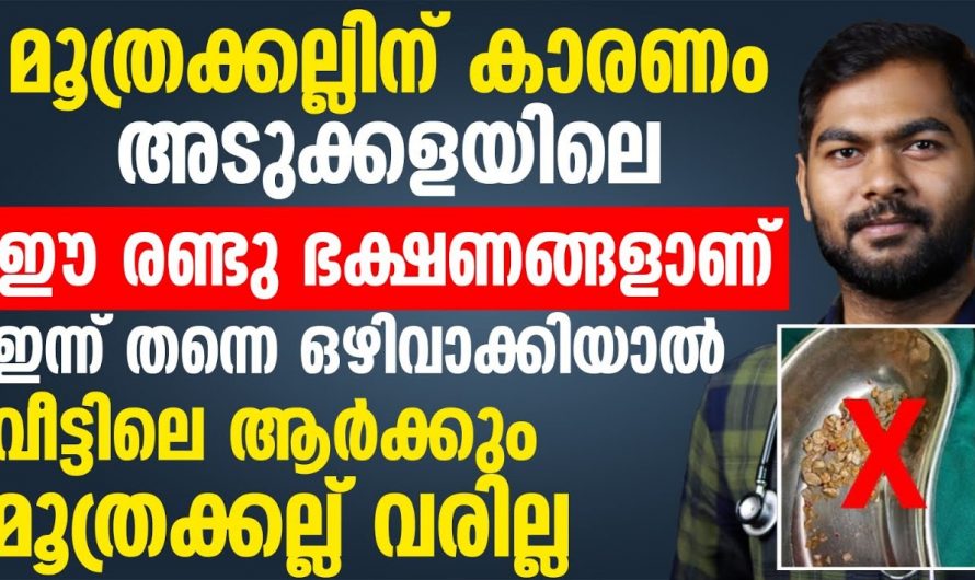 കിഡ്നി സ്റ്റോണിനെ മറികടക്കാൻ അടുക്കളയിൽ നിന്ന് ഇവ ഉപേക്ഷിക്കൂ. ഇതാരും നിസ്സാരമായി തള്ളിക്കളയരുതേ…| Urine stone symptoms