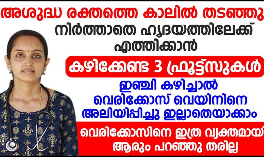 കെട്ടിക്കിടക്കുന്ന അശുദ്ധ രക്തത്തെ ഹൃദയത്തിലേക്ക് എത്തിക്കാൻ ഇതാരും അറിയാതെ പോകരുതേ…| Varicose veins treatment methods