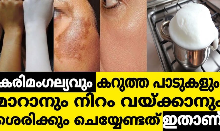 ഈ ആയുർവേദ ഫേയ്സ്പാക്ക് ഉപയോഗിക്കൂ കരിമംഗല്യത്തെ വേരോടെ തുടച്ചുനീക്കാം. ഇതാരും നിസ്സാരമായി കാണല്ലേ.