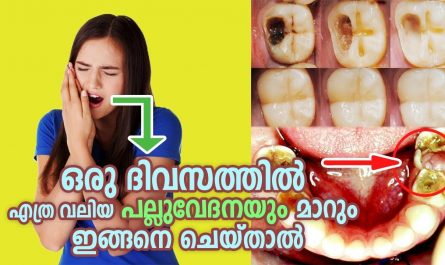 Instant toothache pain relief