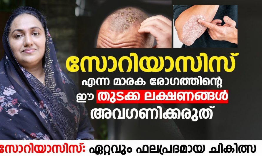 സോറിയാസിസിന്റെ ഇത്തരം ലക്ഷണങ്ങളെ തിരിച്ചറിഞ്ഞില്ലെങ്കിൽ തീരാനഷ്ടം ആയിരിക്കും ഫലം…| How to treat Psoriasis