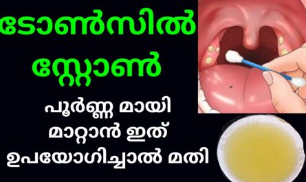 Tonsil Stone Treatment in Malayalam