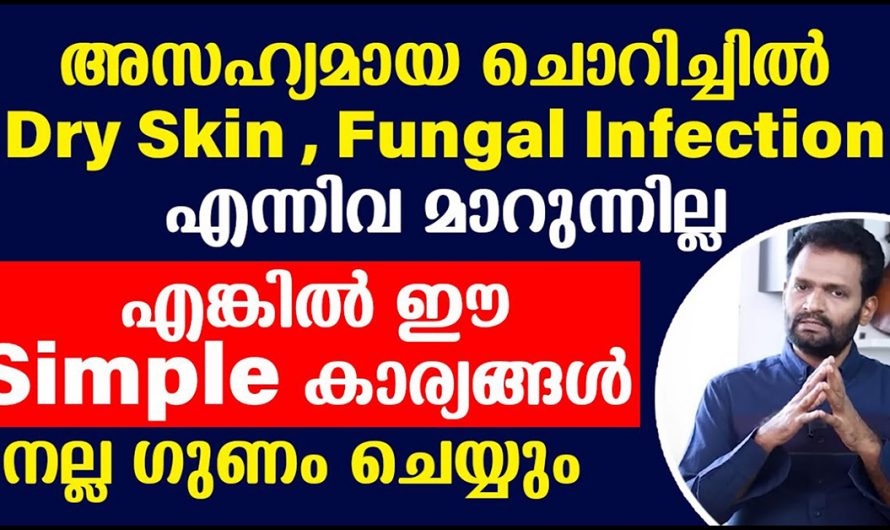 വിടാതെ പിന്തുടരുന്ന ചർമ്മ രോഗങ്ങളെ പ്രതിരോധിക്കാൻ ഇങ്ങനെ ചെയ്താൽ മതി. ഇതാരും നിസ്സാരമായി കാണരുതേ…| Dry skin fungal infection treatment